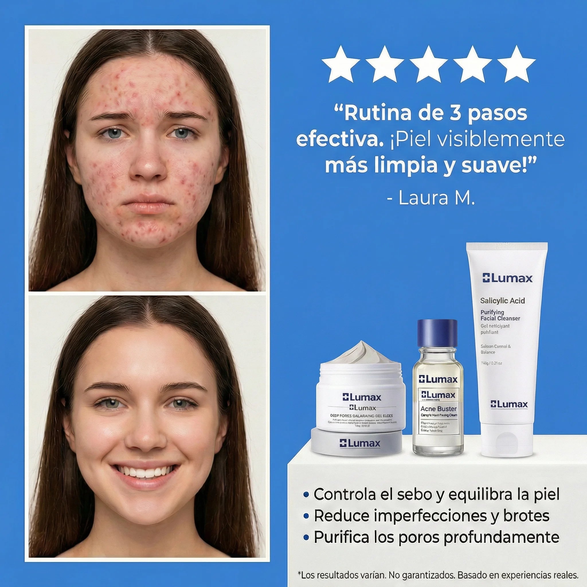 Tratamiento Completo™ | Control Inteligente del Sebo y Brotes Recurrentes